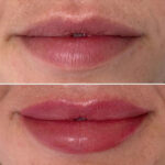 Lip Tattooing | Restore Cosmetic and Medical Tattooing