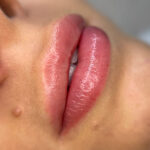 Lip Tattooing | Restore Cosmetic and Medical Tattooing