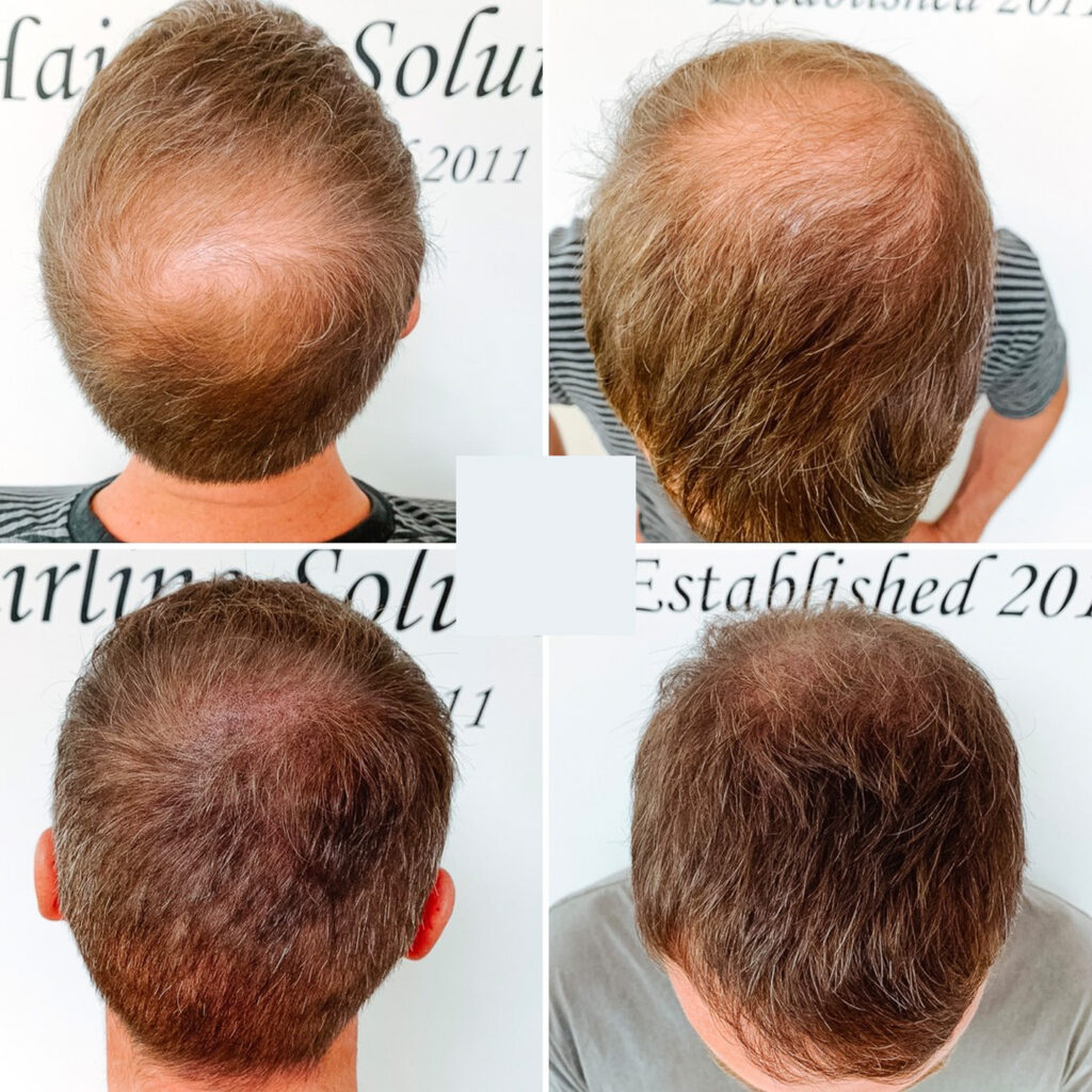 Scalp Tattooing | Restore Cosmetic and Medical Tattooing